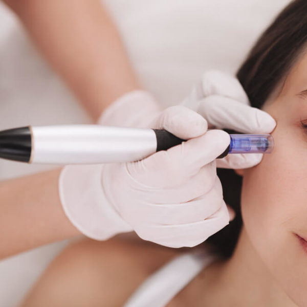 microneedling being done